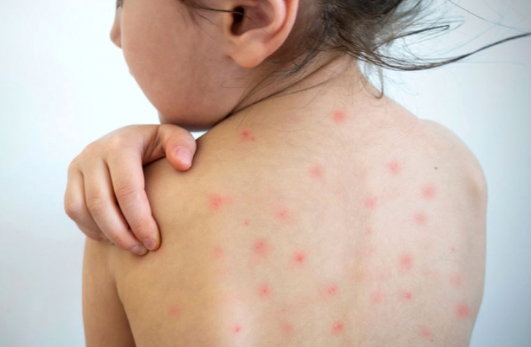 4 casos de sarampión en el EdoMéx