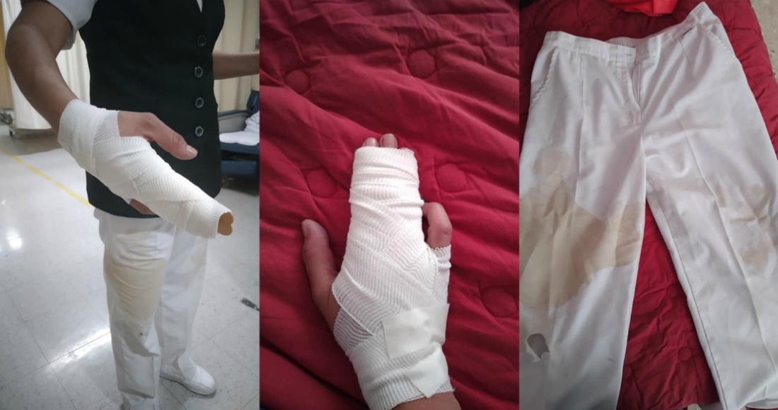 Le tiran café hirviendo a enfermera por temor al Covid-19