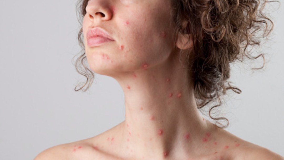 Aumentan-los-casos-de-sarampión-en-el-Edomex