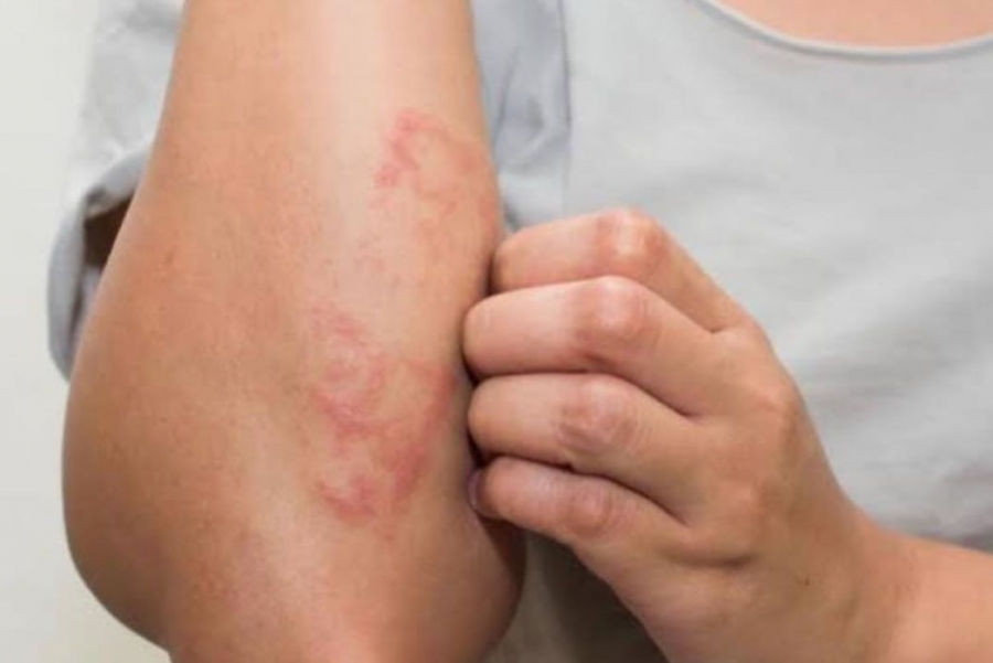 Se-registran-nuevos-casos-de-lepra-en-Mexico