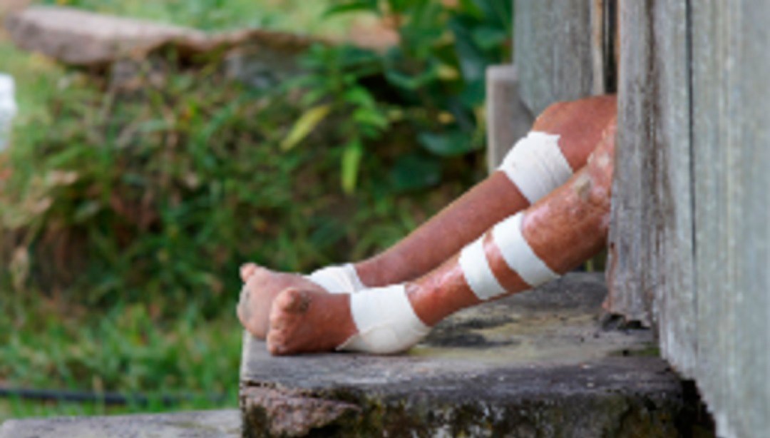 Lanzan alerta nacional en México debido a la aparición de varios casos de lepra en 18 estados de la República.