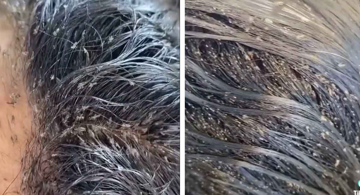 niña con piojos se hace viral en texas