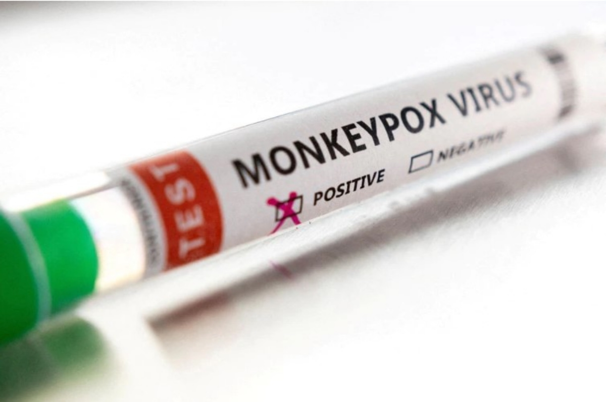 Casos de la Viruela del mono en la capital mexiquense