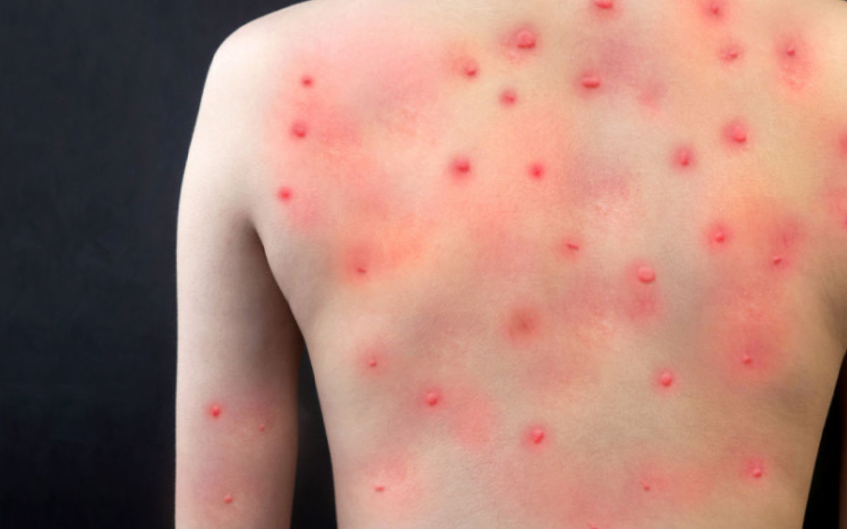 espalda con viruela del mono
