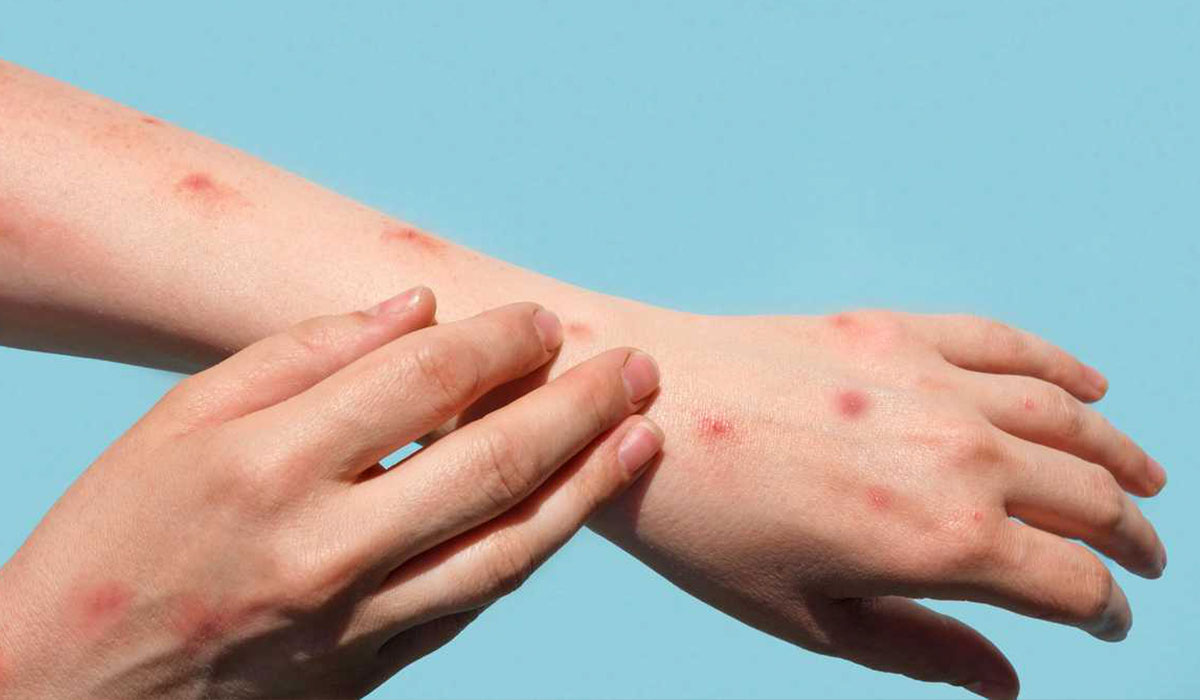 ¡Va a suceder otra vez!, reportan dos casos de viruela del mono en Toluca