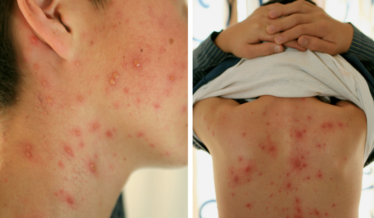 Viruela de Mono cambia su nombre